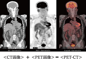 PET-CTイメージ